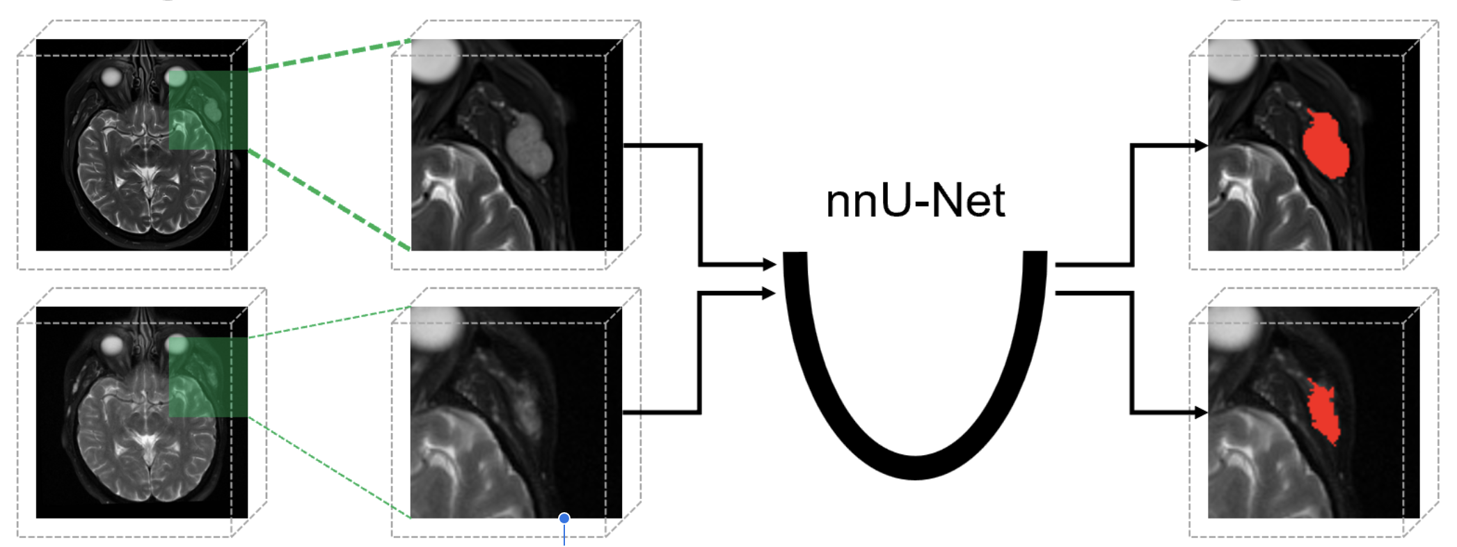 Vascular Malformation Segmentation